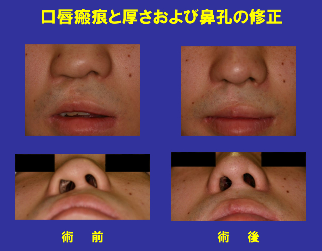 口唇瘢痕と厚さおよび鼻孔の修正