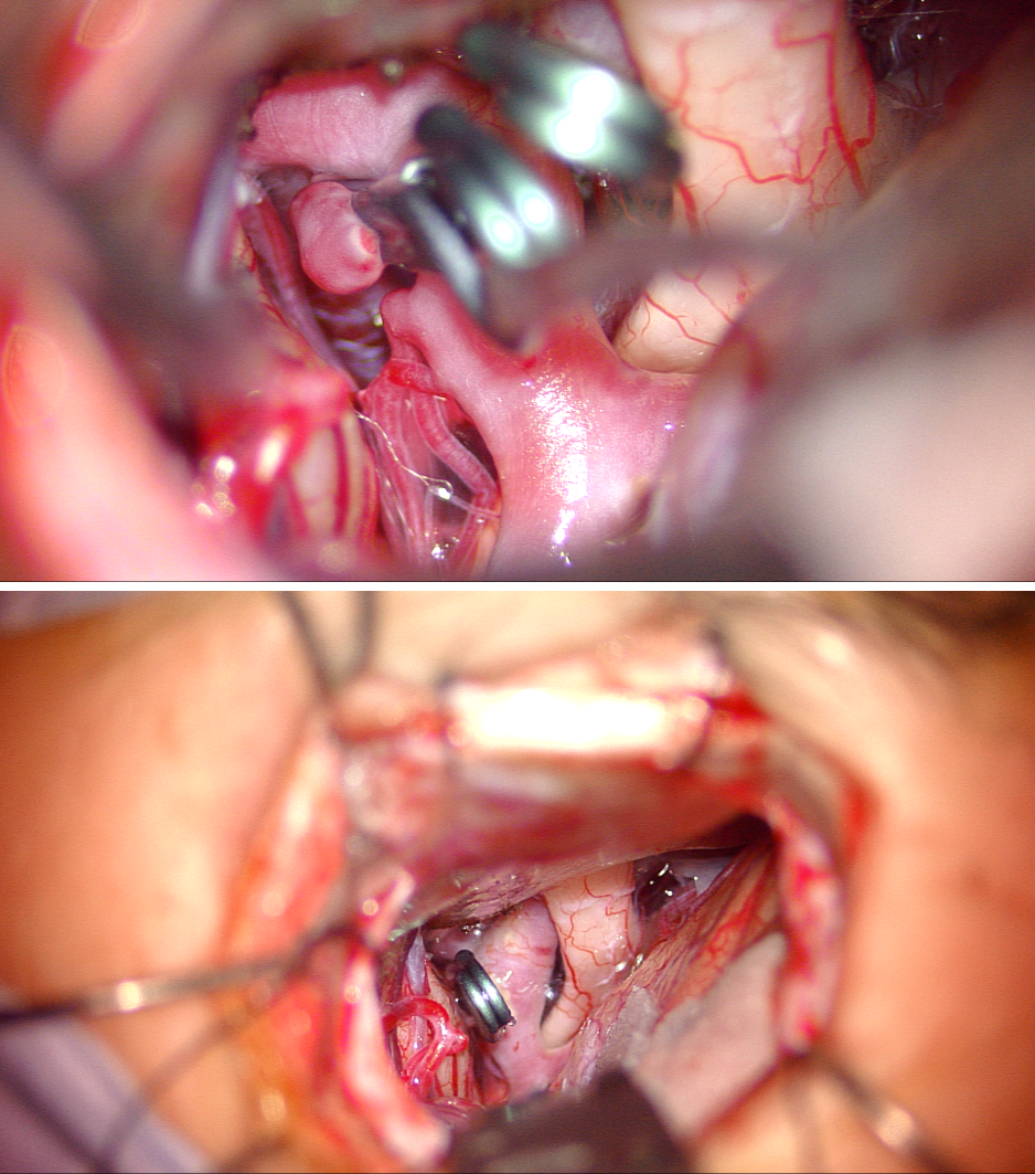 脳動脈瘤に対する鍵穴手術・クリッピング術の様子