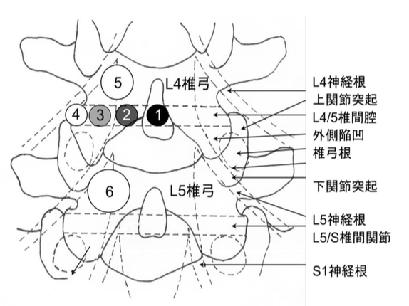 腰椎椎間板ヘルニアの発現部位