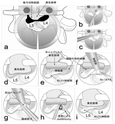顕微鏡手術下腰椎椎間板ヘルニア摘出術の手順