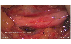 尺骨神経の顕微鏡下滅圧手術所見