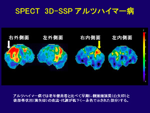 アルツハイマー病のSPCET画像