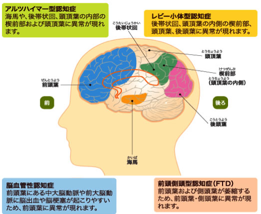 認知症の種類