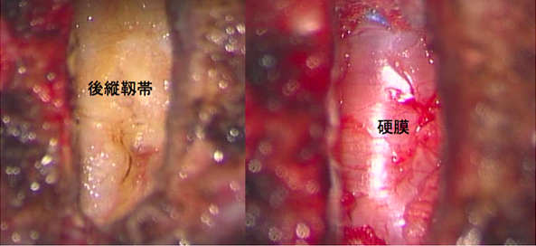 頸椎症性脊髄症に対する頸椎前方除圧固定術