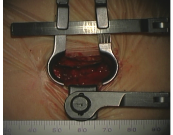 小型の開創器(Piccolino retractor)