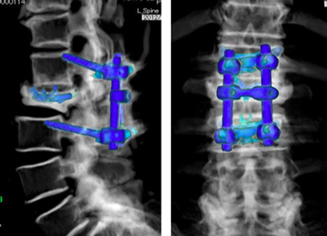 圧迫 腰椎 第 骨折 三 腰椎圧迫骨折とは？原因や症状、治療方針は？