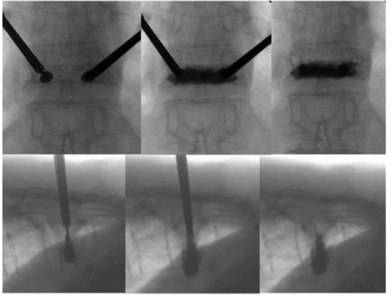 脊椎圧迫骨折BKP療法時の術中X線写真