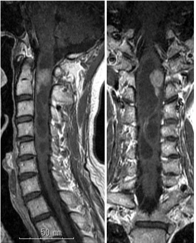脊髄髄内腫瘍（上衣腫）