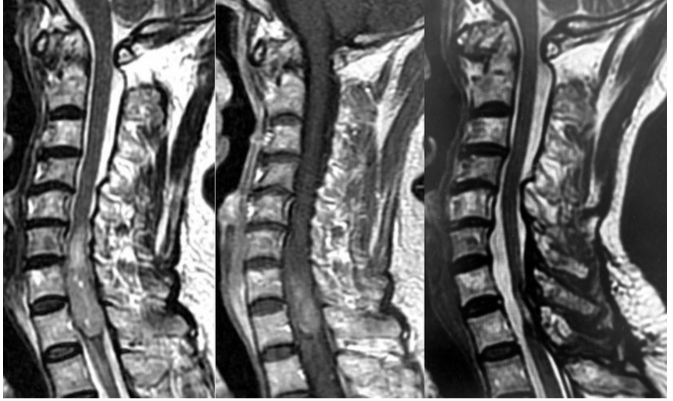 頸髄髄内腫瘍（上衣腫）