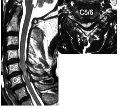 頸椎症性脊髄症の頸椎MRI