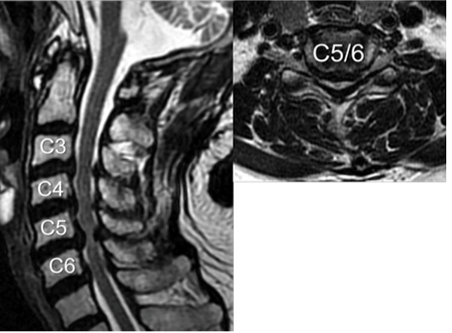 頸椎症性脊髄症の頸椎MRI