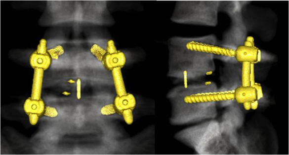 TLIF術後3D-CT