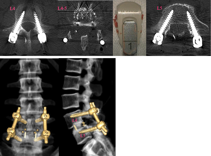 PLIF術後CTおよび3D-CT