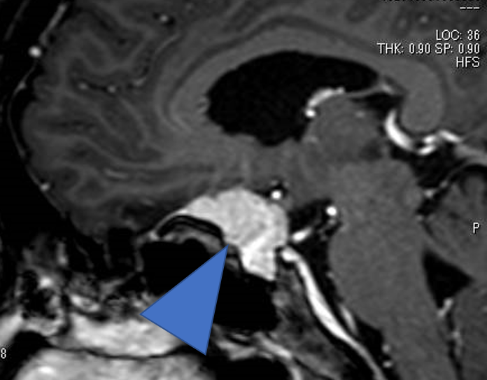 脳腫瘍・術前MRI