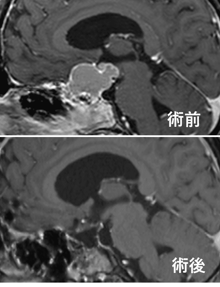 頭蓋咽頭腫瘍の術前術後