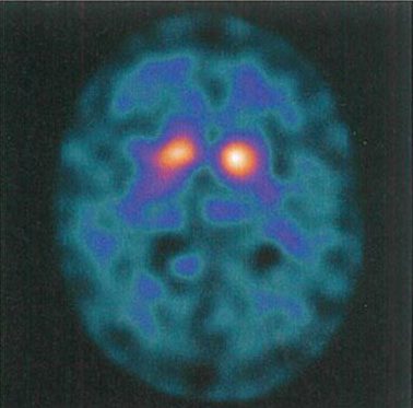 パーキンソン病患者のDAT-Scan画像