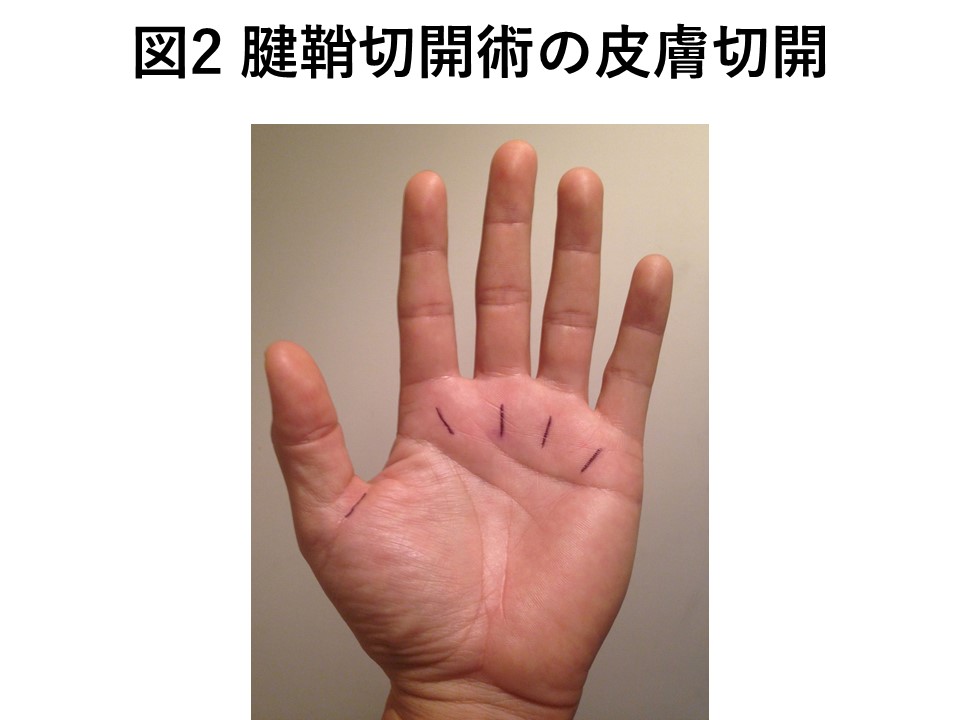 腱鞘切開術の皮膚切開