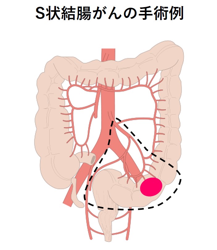 S状結腸がんの手術例