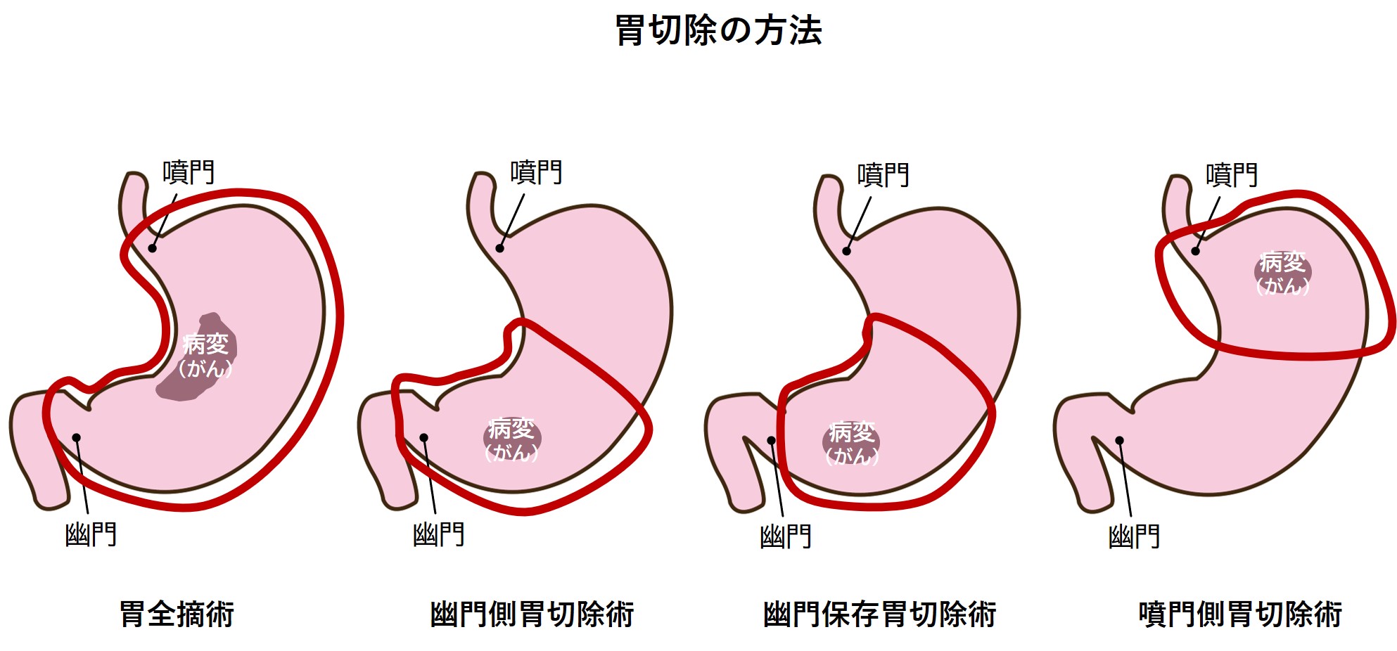 胃切除の方法