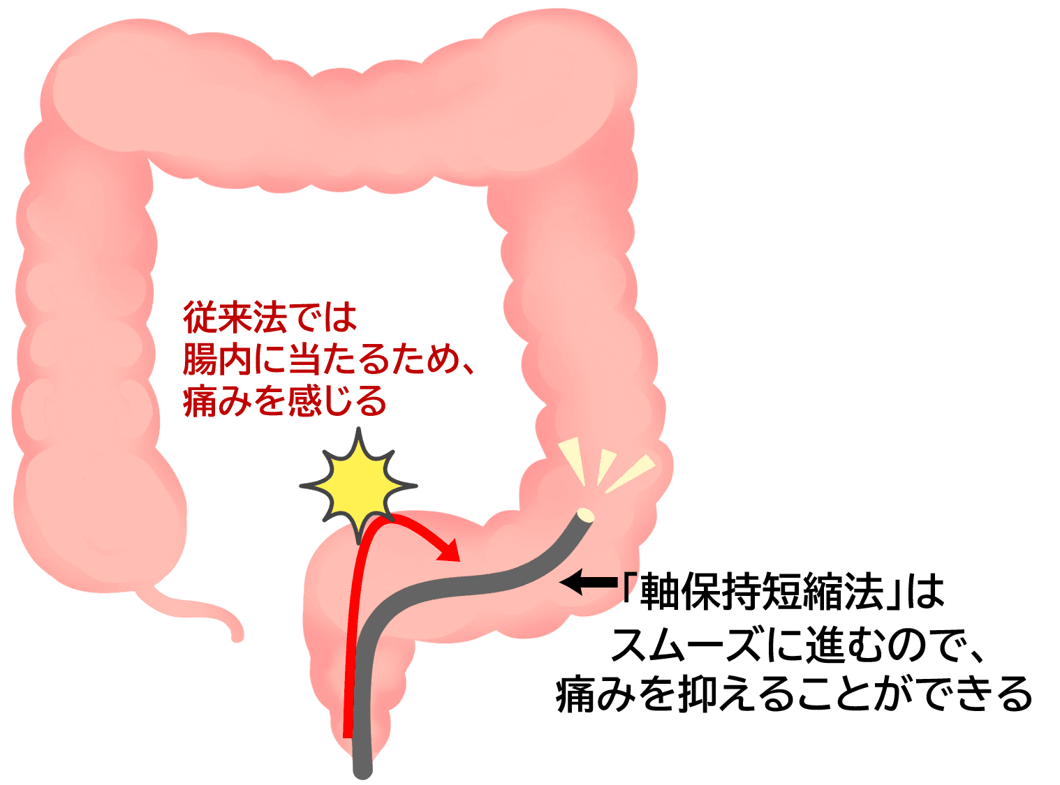 大腸内視鏡検査の軸保持短縮法