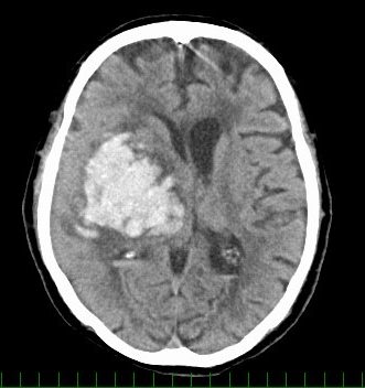 脳出血に対する開頭血腫除去術の症例画像（術後）