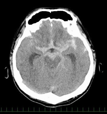くも膜下出血直後のCT画像
