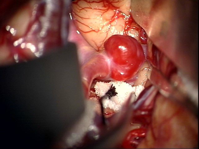 実際の手術で見られた脳動脈瘤