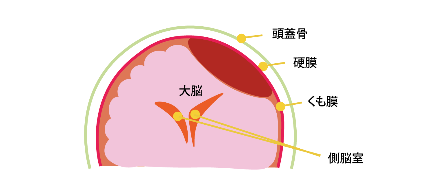 慢性硬膜下血腫のイラスト