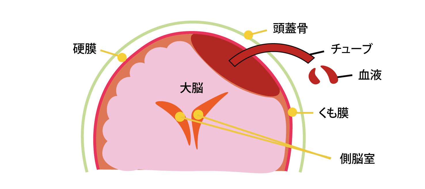 穿頭血腫除去術のイラスト