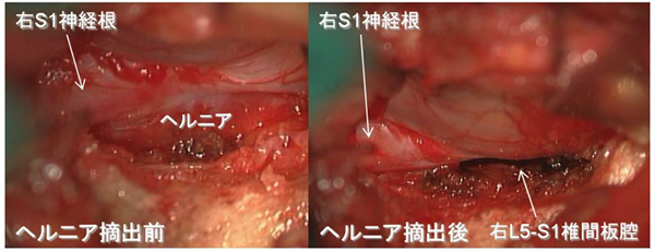 Piccolino開創器を使用した手術例