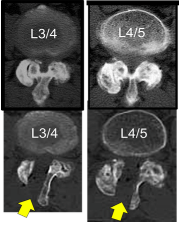 腰部脊柱管狭窄症の術前術中CT