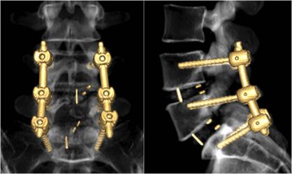 経皮的椎弓根スクリュー挿入法の術後3D-CT