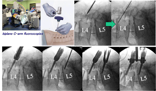 MISS-CBT法による椎弓根スクリュー挿入およびロッド留置までの手技