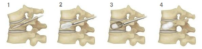 脊椎圧迫骨折に対するBKP療法の手技