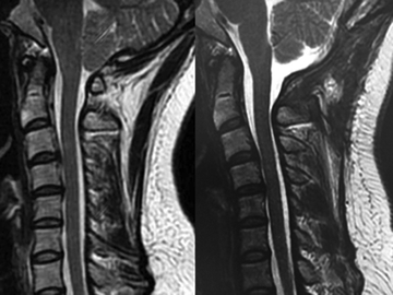 キアリ奇形の頭蓋頸部MRI