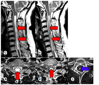 脊髄空洞症例に対する空洞－クモ膜下腔短絡術