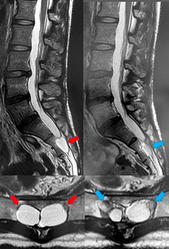 仙骨嚢胞のMRI