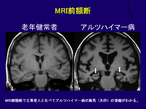 アルツハイマー病のMRI前額断