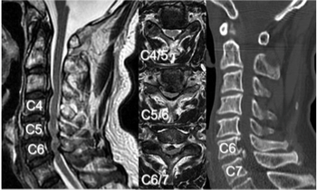多椎間レベルの頸椎症性脊髄症のMRI