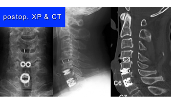 片開き式頸椎椎弓形成術後の頸椎単純X線