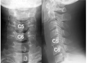 頸椎椎間板ヘルニアの術後頚椎XP