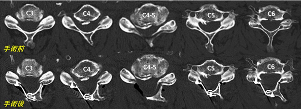 片開き式頸椎椎弓形成術前後の頸椎CT