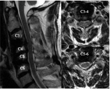分節型の頸椎後縦靱帯骨化症の術後頸椎MRI