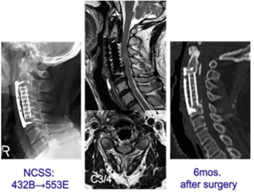 頸椎後縦靱帯骨化症の術後頸椎単純X線