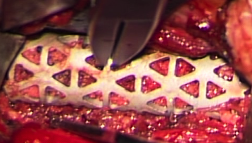 後縦靱帯骨化摘出後のチタン製人工椎体留置