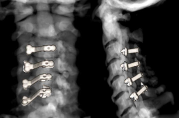 呼吸障害を伴った頸椎OPLLの術後3D-CT