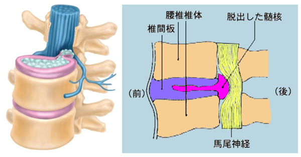 腰椎椎間板ヘルニアの立体模式図