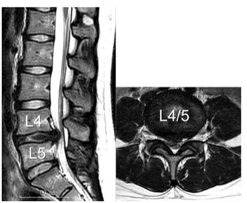 腰椎椎間板ヘルニアのMRI所見