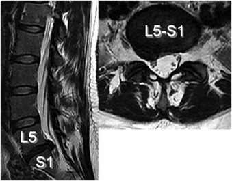 椎間板ヘルニアの腰椎MRI像