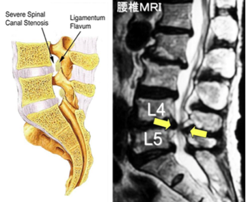 腰部脊柱管狭窄症の模式図と腰椎MRI